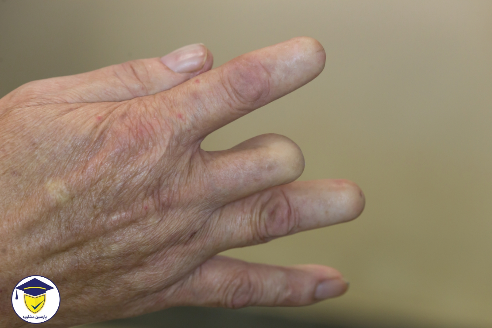 معافیت پزشکی قطع انگشت دست