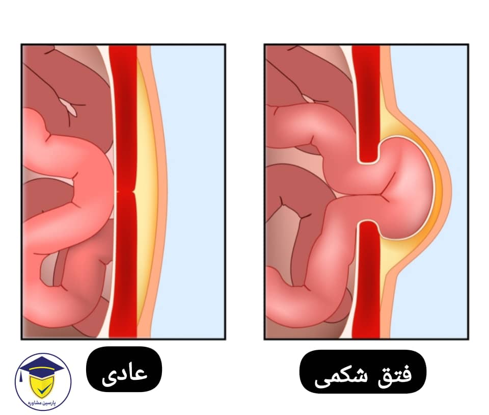 شرایط گرفتن معافیت پزشکی فتق
