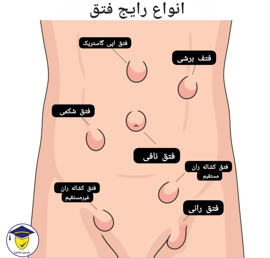 معافیت پزشکی فتق-انواع فتق